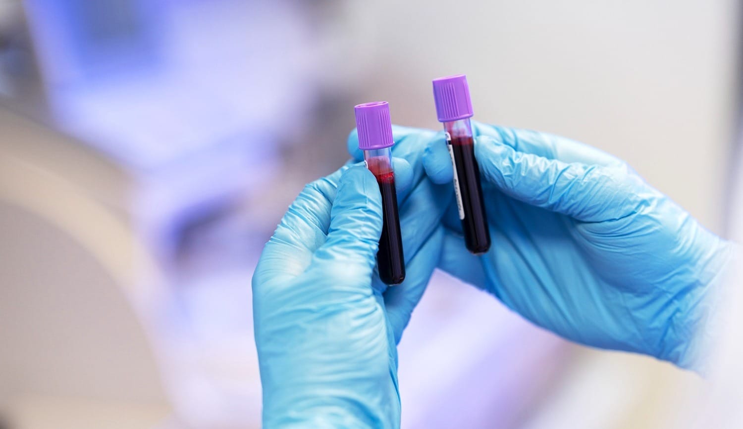 Histamine Intolerance Test. Blood test vials for histamine intolerance DAO enzyme testing in medical laboratory for