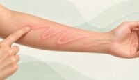 Dermatographia skin writing with raised linear hives on the forearm
